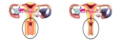 vagina enhancement surgery pictures Vagina enhancement surgery pictures